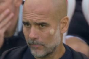 😲这是什么？瓜迪奥拉左脸颊有一块白色